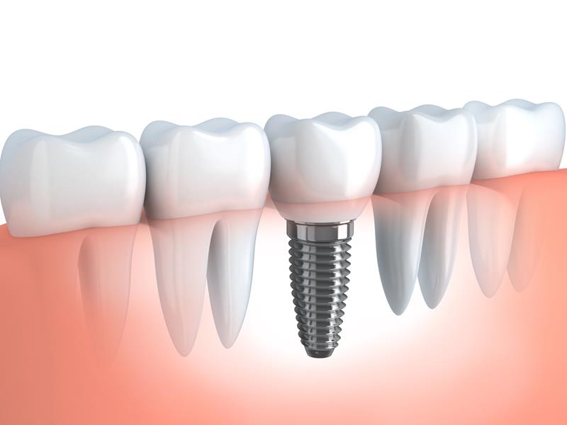 Dental Implants  Briarwood, NY 